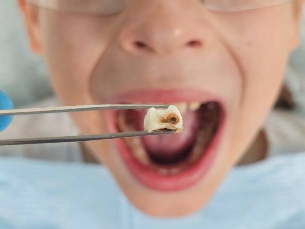 Best Emergency Wisdom Teeth Removal in Cross Plains, TX
